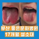 좋은문화병원 | 돌 이후 설소대 수술 괜찮을까? 부산 좋은문화병원 17개월 아기 비수면 수술 후기