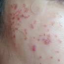 대호사 | 휴직기간 to do list-기미잡티 없애기(2)