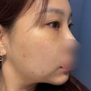 200 | 신사역 피부과 순자리프팅 (온다 8만줄 + 올타이트 200샷) 후기