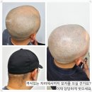 스칼프라임SMP | 울산두피관리 스칼프바이브,머리숱으로 바뀐 나의 인생 가르마
