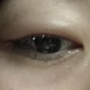 서울아이성형외과의원 | 서울 컴포트 성형외과 아이라인 문신 제거 후기 +붓기