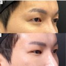 여우눈꼬리 | 눈꼬리올리기 여우눈성형 끝판왕 눈꼬리올리기후기 리터닝성형외과