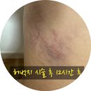 뾰로롱 | 확실한 다이어트법 ! 망포지방분해주사 &gt;&gt; 허벅지제로팻주사 1회차 후기 뾰로롱 ★