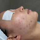 모아드 | [내돈내산] 건대피부샵 추천 ‘모아드’ 여드름 흉터 치료 여드름 없애는 법! 모낭염 피부 치료