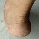 박지영산부인과의원 | 수지구청역 발관리 굳은살제거 발 뒤꿈치 각질제거 찐만족한 레푸스 수지구청점 후기