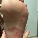 ​6개월간 안 낫던 아기 피부염, 습진 아니라 무좀이라고?? 이석종피부과 어린이아토피 초진 후기
