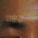지루성피부염 치료방법 고운결한의원~~!