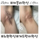 커믈리헤어 | 커믈리왁싱 노원역 왁싱 겨드랑이 왁싱 전후