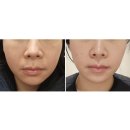 타이탄 | 잠실새내역 피부과에서 이브타이탄 받고온 후기