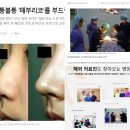 청주코성형 비용후기 잡으세요