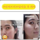 린의원 | (신사역리프팅의원) 저자극 탄력의 린커브리프팅 시술감 후기