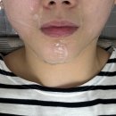 대구피부과 세르프리프팅 300샷 후기