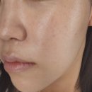 재성한의원 | 셀프박피 천연약초침 약초필링 여드름흉터없애기