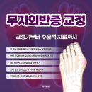구일종합건설(주) | 구일역정형외과 엄지발가락 교정 방법, 교정기부터 수술까지