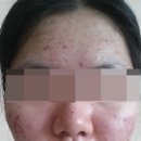 본한의원 | 피부염 전문 한의원에서 다녀본 치료 후기