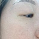 주식회사벳스템솔루션 | 청담 에스테틱 앰플로 관리하는 눈꺼풀 처짐, 셀린토 링클톡스 5D 샷