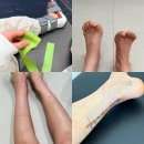 (주)골든메디컬 | 아킬레스건 수술 3주차, 이게 정상인가요? (파열 후 2~3주차 변화 총정리)