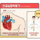 심장 박동기와 제세동기는 뭐가 다른 건가요? 이미지