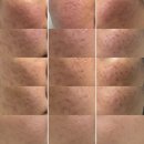 중앙제일한의원 | 울산 한의원 얼굴패인흉터 치료후기(+일주일 경과사진)