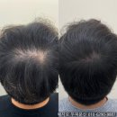 부평종합광고 | 부평두피문신, 내 머리카락처럼 티 안나는 자연스러움이 가능한 이유