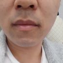 해피메디 | 해피메디 수염제모 6회차 후기