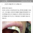 구내혈종 없애는 방법 아시는분 계실까요? 이미지