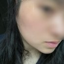 멍 핏 스튜디오 | 청담 연예인 얼굴관리 노하우 소멸핏 통증.멍.붓기 리얼후기