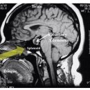 ﻿﻿뇌하수체선종 이란? 이미지