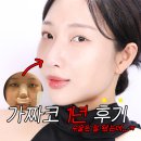 복코돼지 | 코수술 내돈내산 1년 후기. 뷰티블로거의 성형외과 꿀팁 &amp; 진짜 무서웠던 부작용
