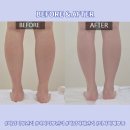 [미사피부관리] 하체관리 잘하는 &lt;그레이스 미사 피부관리&gt; 지방, 셀룰라이트 정리