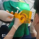 대정도현치과기공소 | 앞니 미니쉬 후기 깨진 치아도 자연스럽게 복구됩니다.