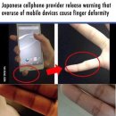 스마트폰 많이 하면 생기는 손가락 모양 이미지