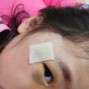 참조은어린이집 | [육아일상] 아이 눈가 찢어짐 봉합 후기(33개월) |성형외과 선택 이유 + 2바늘 꿰매고 왔어요 (관리...