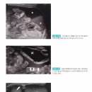 복강내 유리공기/ 액체 이미지