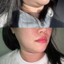 기린성형외과 갸름주사 솔직후기 (전,후 사진있음)내돈내산 가격정보/시술정보