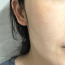 안비뇨기과의원 | 선릉 힐비뇨기과 잡티제거 레이저 후기(예약, 비용, 과정)