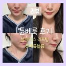 볼륨 | [강남] 한티역피부과 튠베룩(튠페이스+ 쥬베룩볼륨) 내돈내산후기