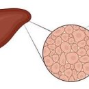 비알콜성 지방간 원인 해결 방법 이미지
