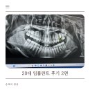 아나나사 | 부산 20대 임플란트 후기 2편