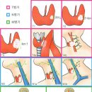 갑상선암 수술-화순전대병원 조직검사결과를 보고 제꺼 결과 이미지