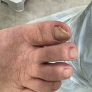 레푸스 앤 두두네일 | 의정부레푸스 : 고민하던 발톱 문제 속시원하게 해결하고 온 후기 [레푸스 앤 두두뷰티]