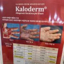 서울화외과의원 | 화상치료일지2(심재성 2도 화상, 화상전문병원, 칼로덤)