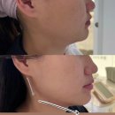 메디뷰제이 | 울산 이중턱 에어젯 내돈내산 2회후기 / 힐링칵테일 1+1 행사 이벤트