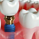 마음심는치과병원 | 대전구암역치과, 임플란트 수술 정말 많이 아플까요?