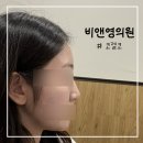 비앤영의원 | 비앤영의원 코젤코 상담 예약 취소로 코수술 3년 앞당기기