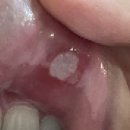 오세진내과의원 | 백신접종 후 흉통, 두근거림, 왼팔저림으로 심장내과에 다녀왔어요. 백혈구수치 이상결과, 입병도 3개나...