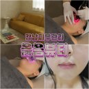 옳음뷰티 | 강남 피부관리 옳음뷰티 알테온 리프팅 후기, 팔자주름 관리