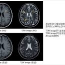 다발성 경화증 원인 증상 치료방법 이미지