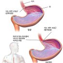 위식도역류질환을 유발하는 생활습관들.위염과 신경성 위장병의 정체 이미지