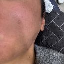 톱스타성형외과의원 | 수원역 울트라클리어 후기! 인계동 청담스타성형외과의원에서 경험한 피부 재생 변화